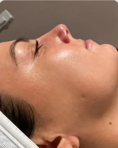 A client's cheek and jawline after dermaplaning at HQ Aesthetics in Melville, Perth