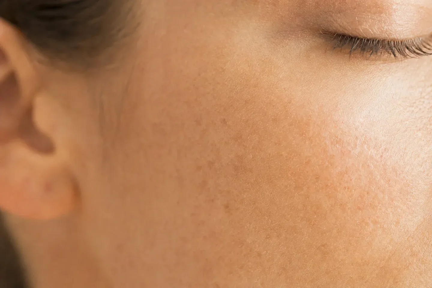 A close view of the cheek and jaw, the area a needling series is aimed at