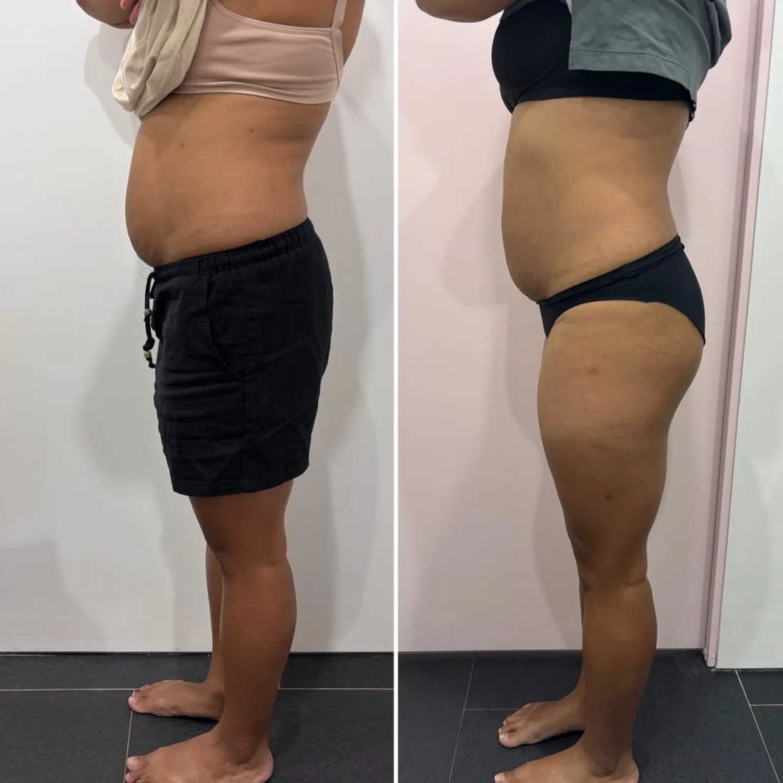 A client's abdomen before and after body sculpting at HQ Aesthetics in Melville, Perth