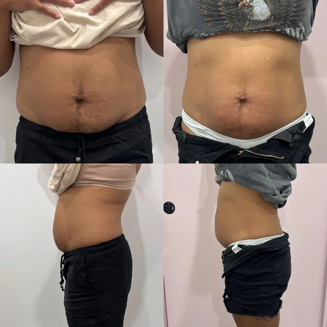 A client's abdomen before and after body sculpting at HQ Aesthetics in Melville, Perth, shown from the front and the side