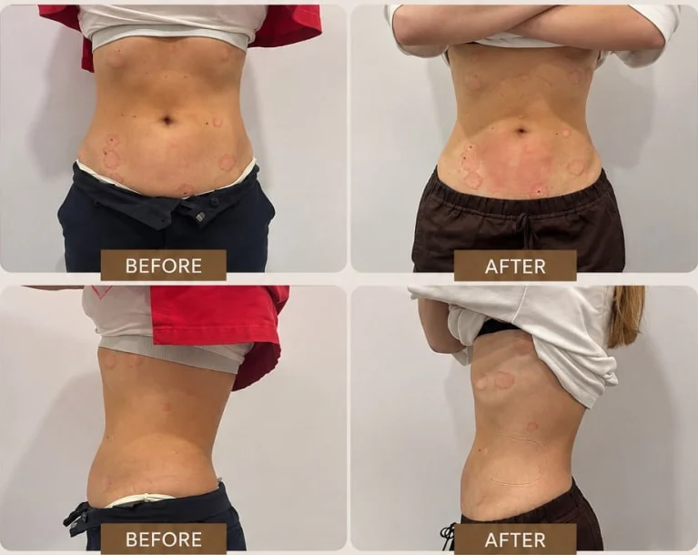 A client's abdomen before and after EMS body sculpting at HQ Aesthetics in Melville, Perth, shown from the front and the side