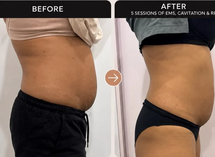 A client's waist in profile before and after EMS, fat cavitation and radiofrequency at HQ Aesthetics in Melville, Perth