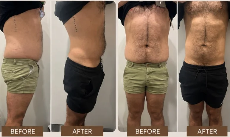 A male client's abdomen before and after a course of EMS and fat cavitation at HQ Aesthetics in Melville, Perth, shown from the front and the side