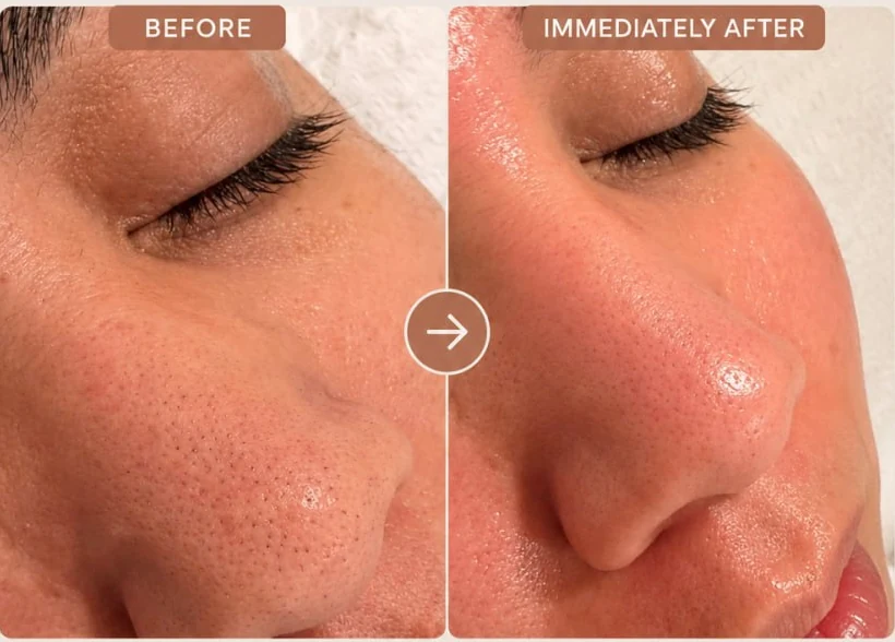 A client's cheek and nose before and immediately after a Dermalogica Pro Power Peel at HQ Aesthetics in Melville, Perth
