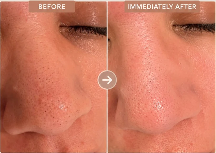 A client's nose photographed close up before and immediately after a Dermalogica Pro Power Peel at HQ Aesthetics in Melville, Perth