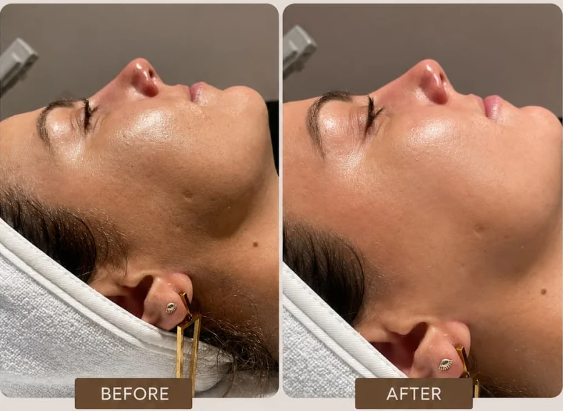 A client's cheek and jaw before and after dermaplaning at HQ Aesthetics in Melville, Perth