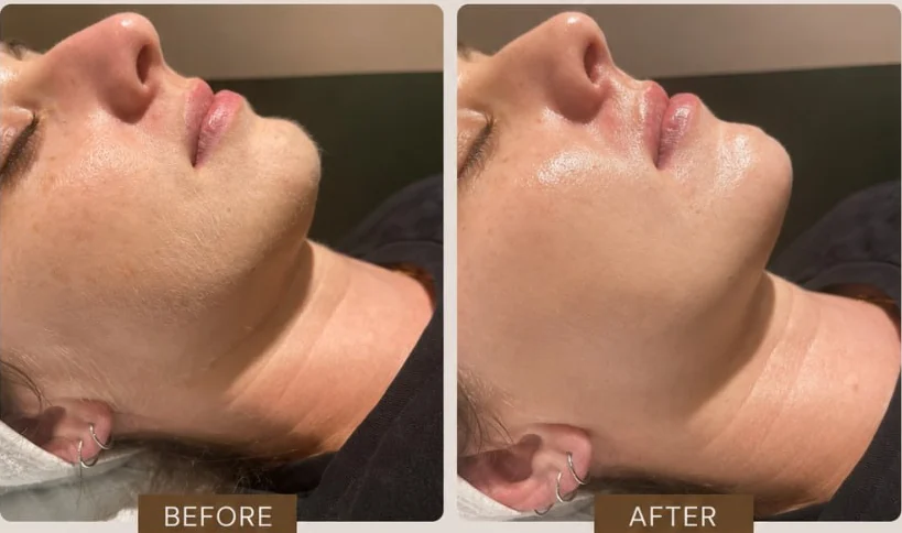 A client's jaw and neck before and after dermaplaning at HQ Aesthetics in Melville, Perth