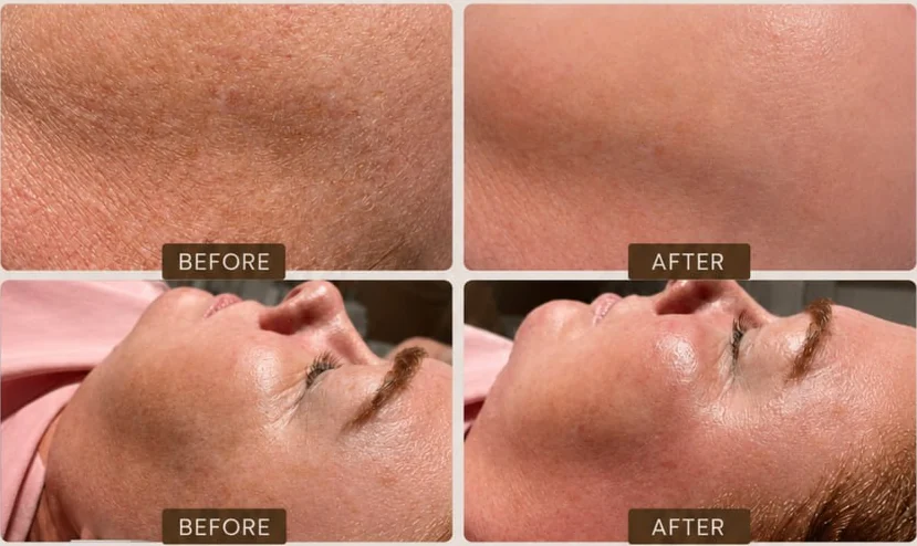 A client's cheek and jaw before and after dermaplaning at HQ Aesthetics in Melville, Perth, shown close up and in profile