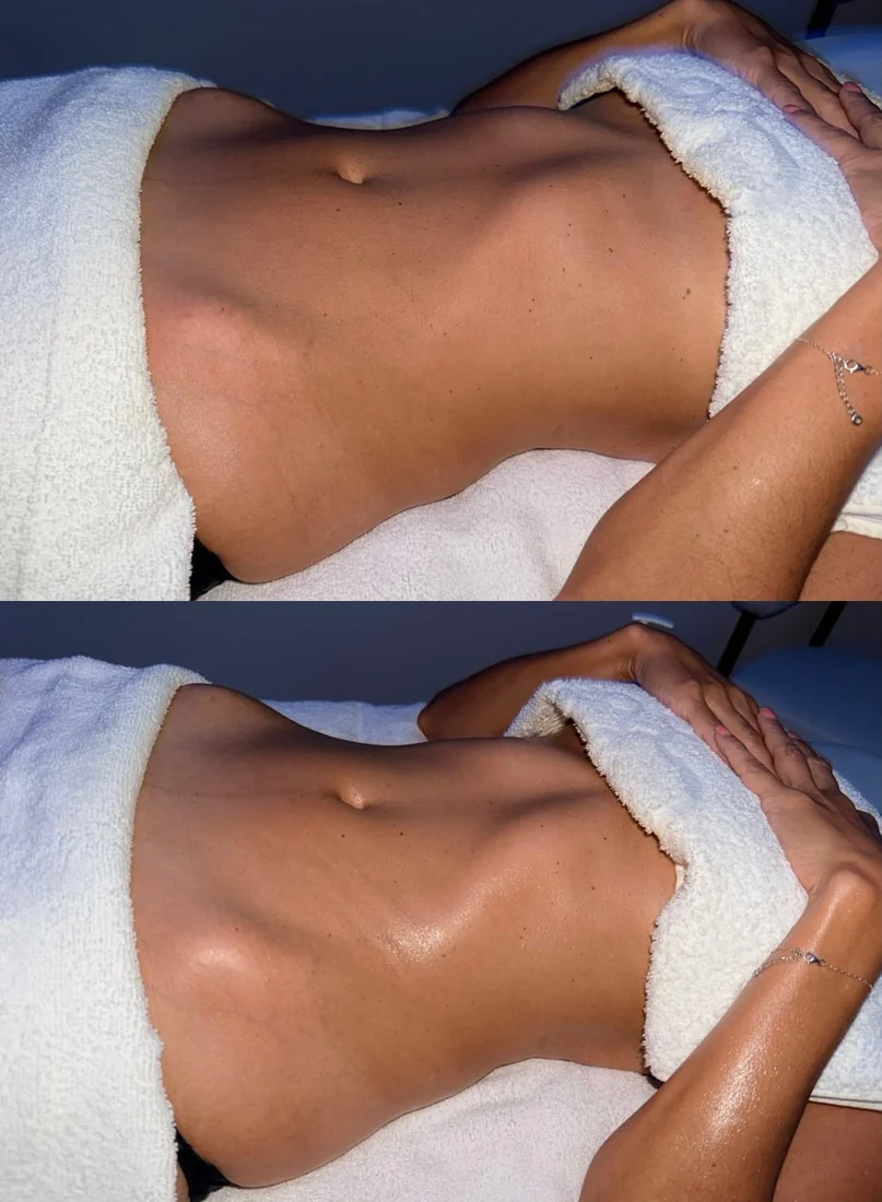 A client's abdomen before and after lymphatic drainage massage at HQ Aesthetics in Melville, Perth