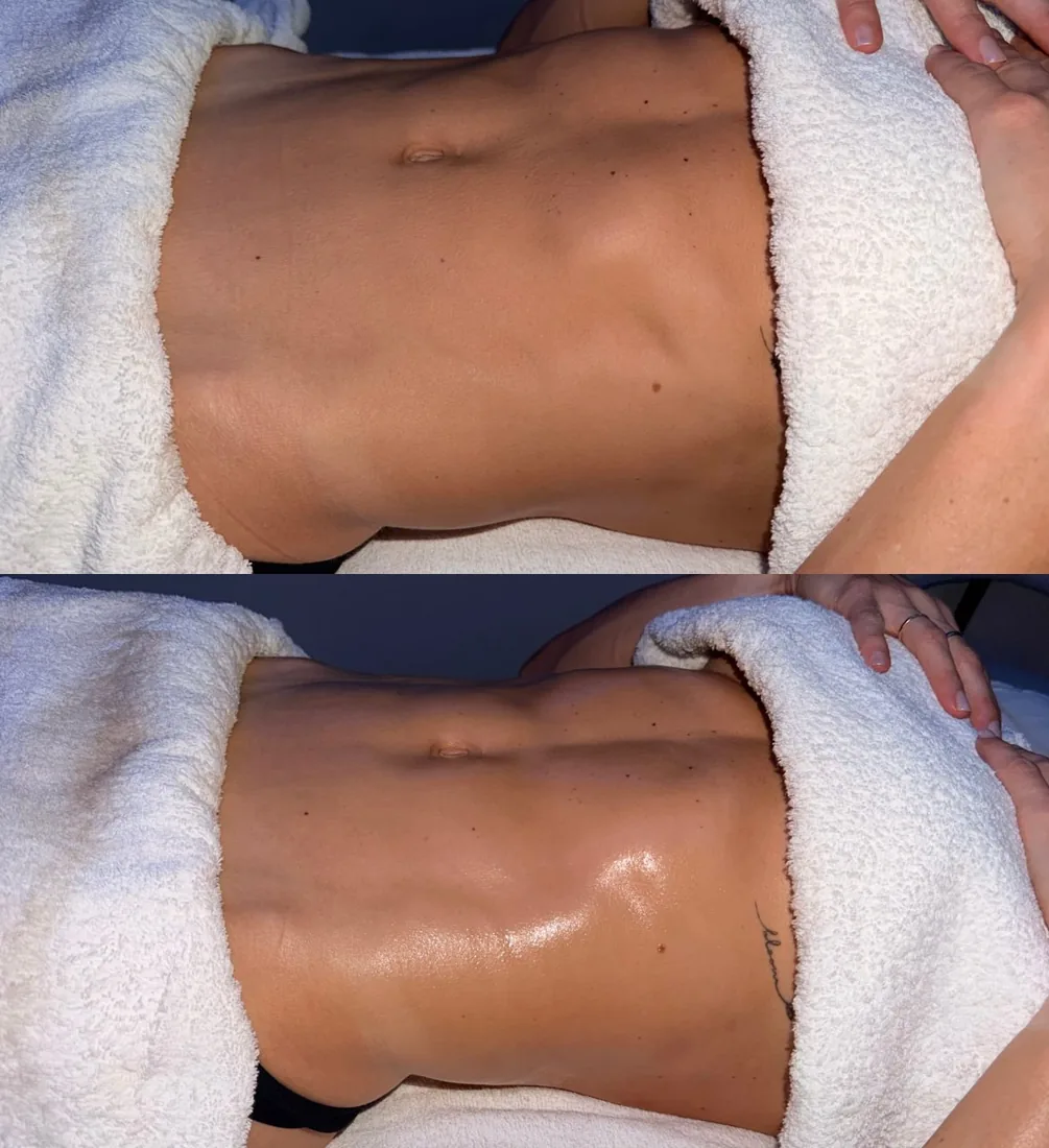 A client's abdomen before and after lymphatic drainage massage at HQ Aesthetics in Melville, Perth