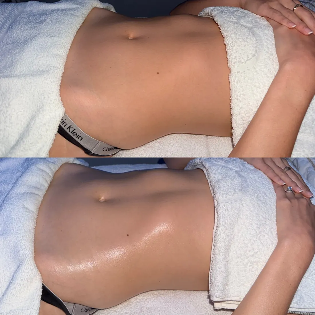 A client's abdomen before and after lymphatic drainage massage at HQ Aesthetics in Melville, Perth