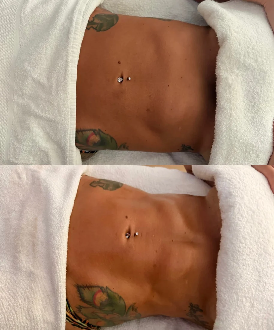 A client's abdomen before and after lymphatic drainage massage at HQ Aesthetics in Melville, Perth
