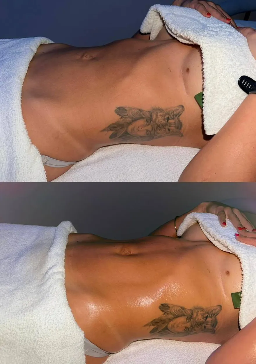 A client's abdomen before and after lymphatic drainage massage at HQ Aesthetics in Melville, Perth