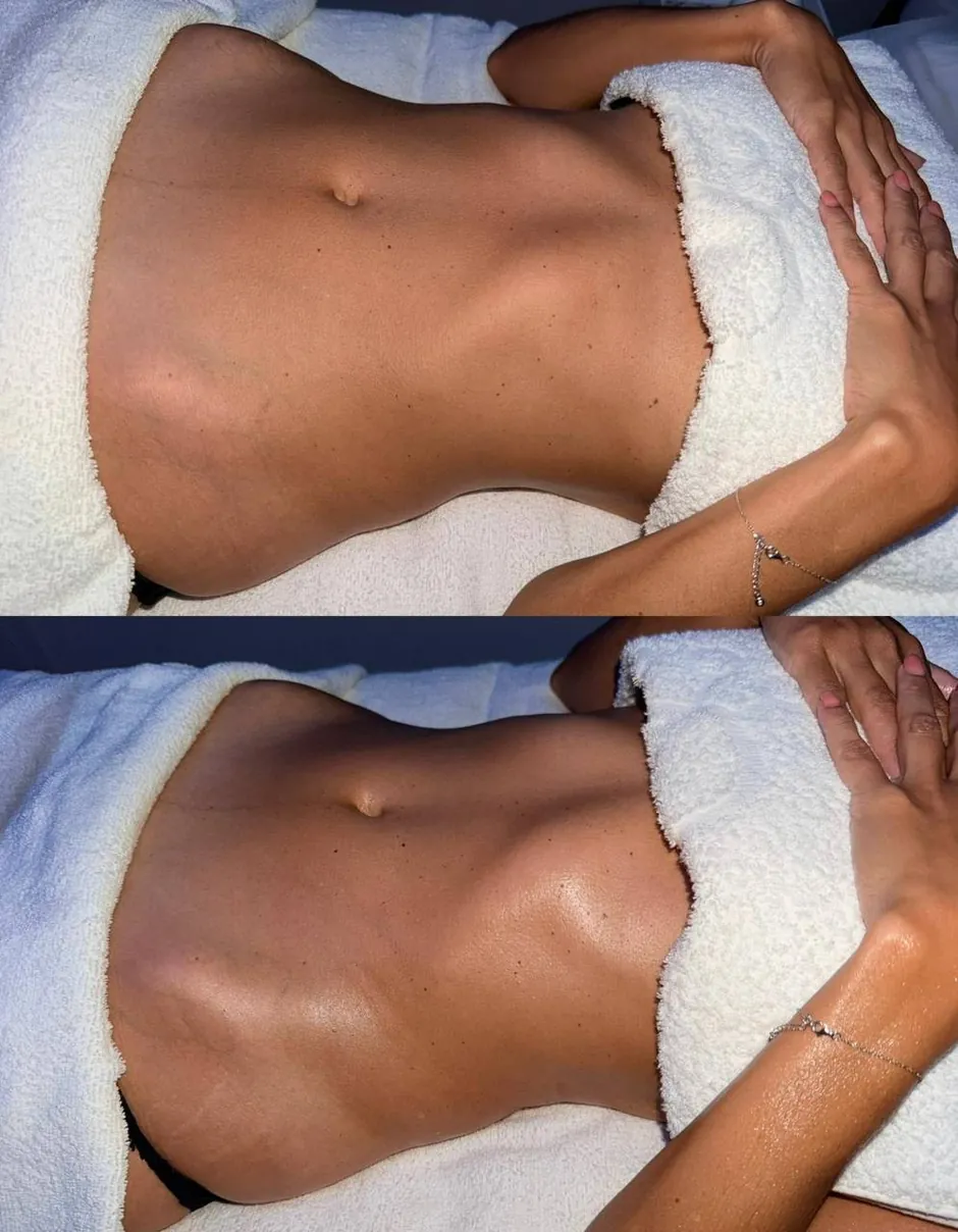A client's abdomen before and after lymphatic drainage massage at HQ Aesthetics in Melville, Perth