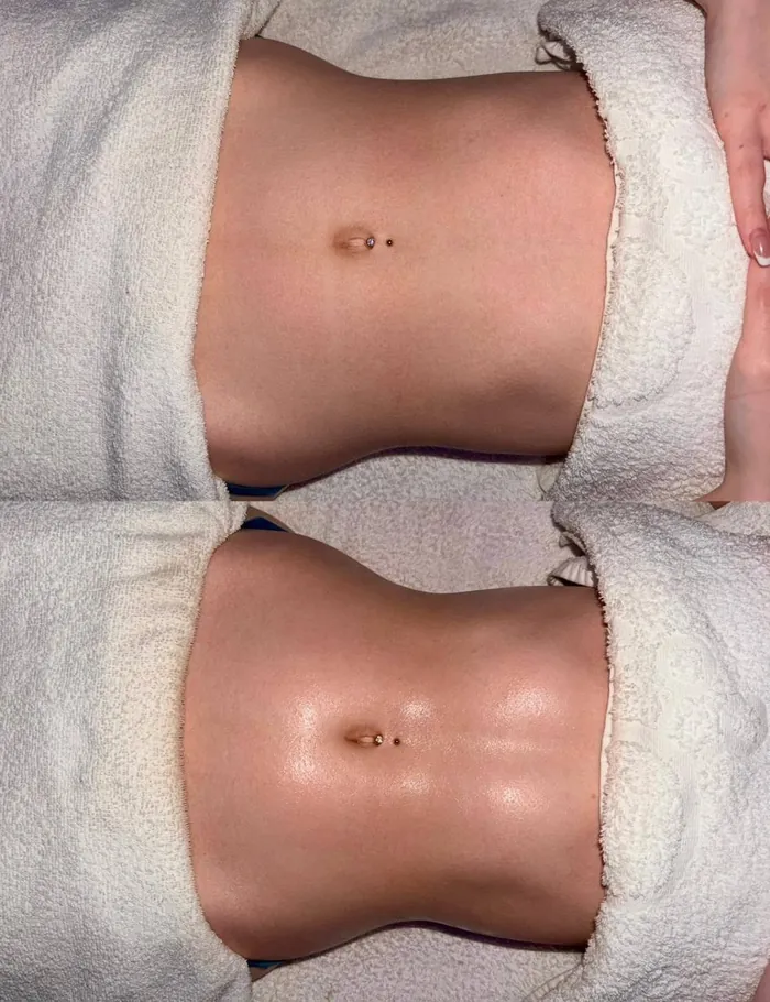 A client's abdomen before and after lymphatic drainage massage at HQ Aesthetics in Melville, Perth