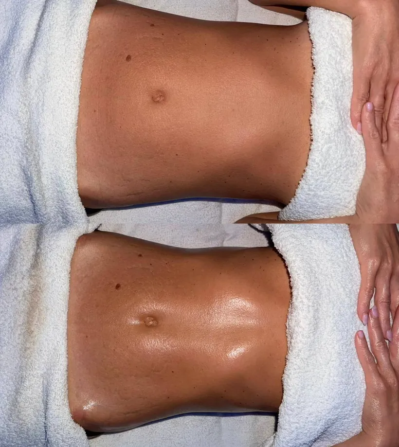 A client's abdomen before and after lymphatic drainage massage at HQ Aesthetics in Melville, Perth