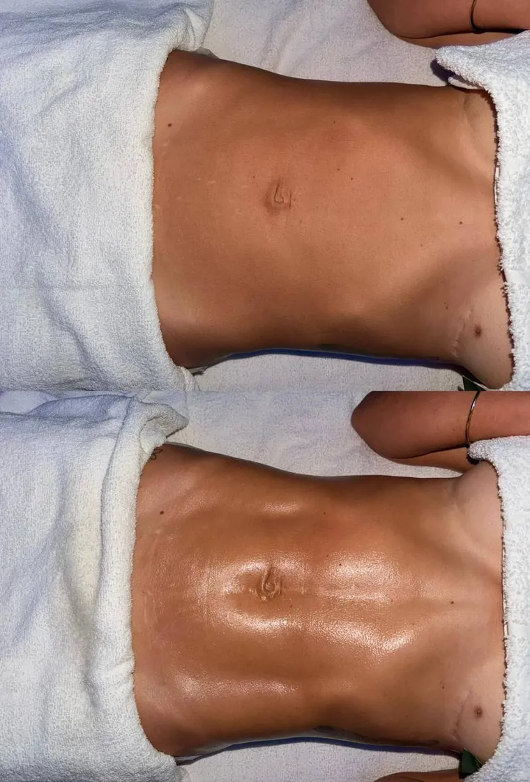 A client's abdomen before and after lymphatic drainage massage at HQ Aesthetics in Melville, Perth
