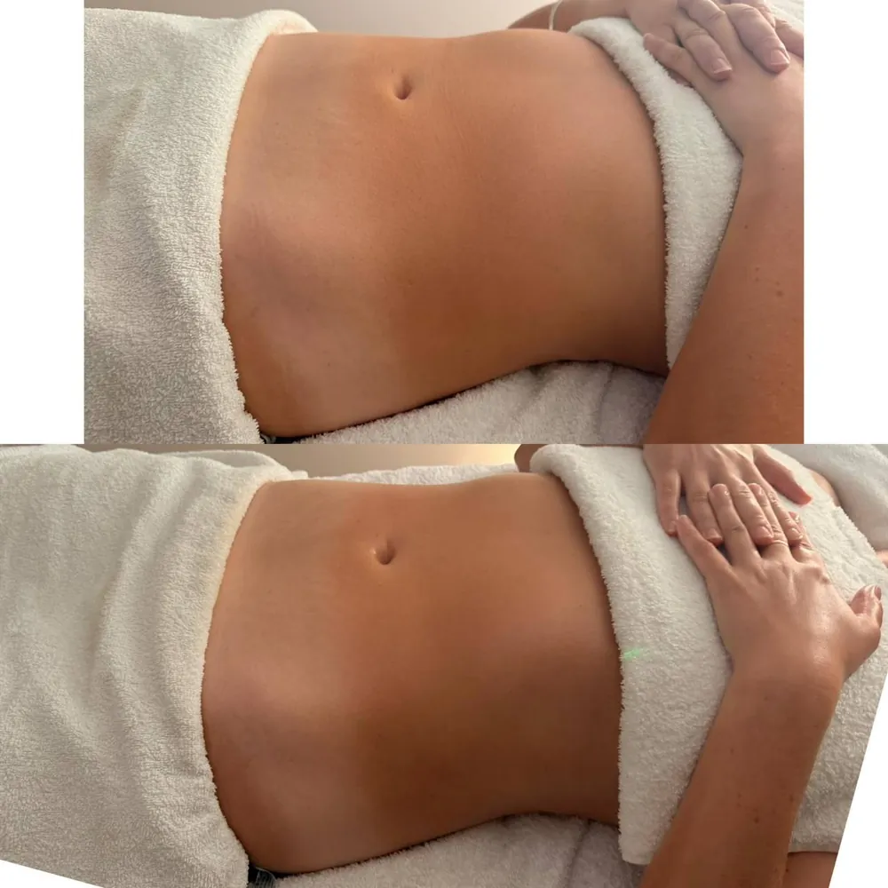 A client's abdomen before and after lymphatic drainage massage at HQ Aesthetics in Melville, Perth