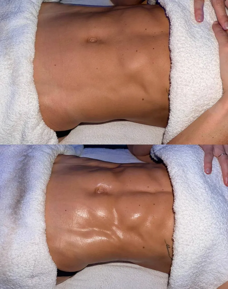 A client's abdomen before and after lymphatic drainage massage at HQ Aesthetics in Melville, Perth