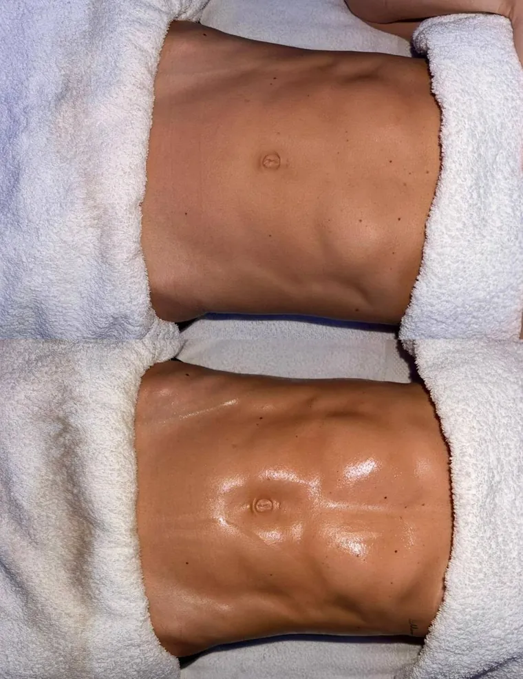 A client's abdomen before and after lymphatic drainage massage at HQ Aesthetics in Melville, Perth