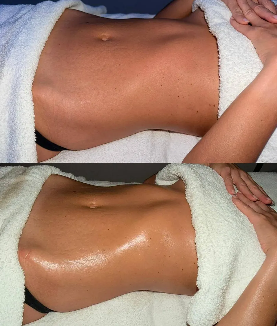 A client's abdomen before and after lymphatic drainage massage at HQ Aesthetics in Melville, Perth