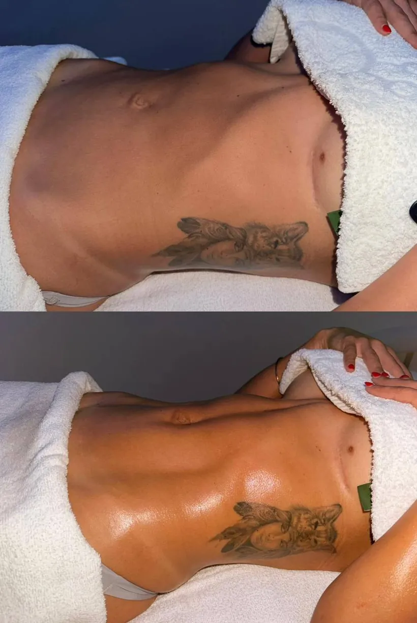 A client's abdomen before and after lymphatic drainage massage at HQ Aesthetics in Melville, Perth