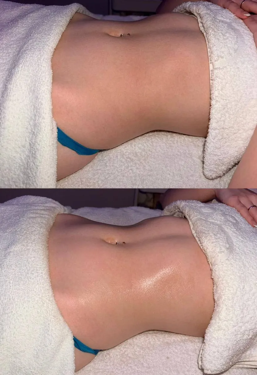 A client's abdomen before and after lymphatic drainage massage at HQ Aesthetics in Melville, Perth
