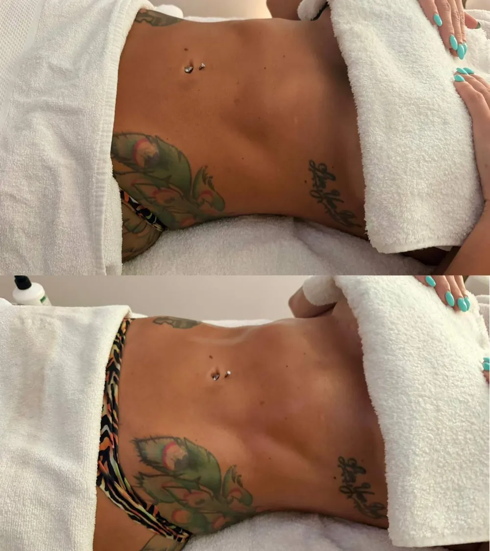 A client's abdomen before and after lymphatic drainage massage at HQ Aesthetics in Melville, Perth