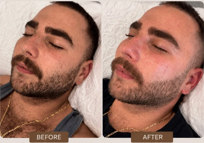 A male client's face before and after skin needling at HQ Aesthetics in Melville, Perth