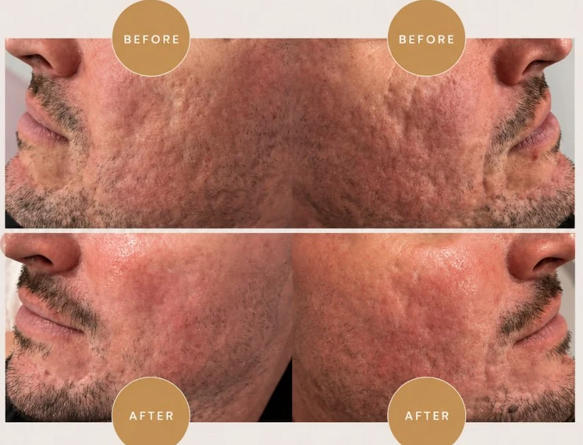 A male client's cheeks photographed on both sides before and after Exo Booster skin needling for acne scarring at HQ Aesthetics in Melville, Perth