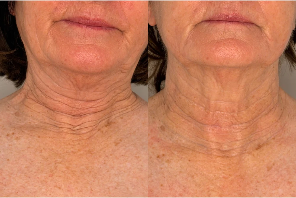 A client's neck photographed from the front before and after T33 cold plasma at HQ Aesthetics in Melville, Perth