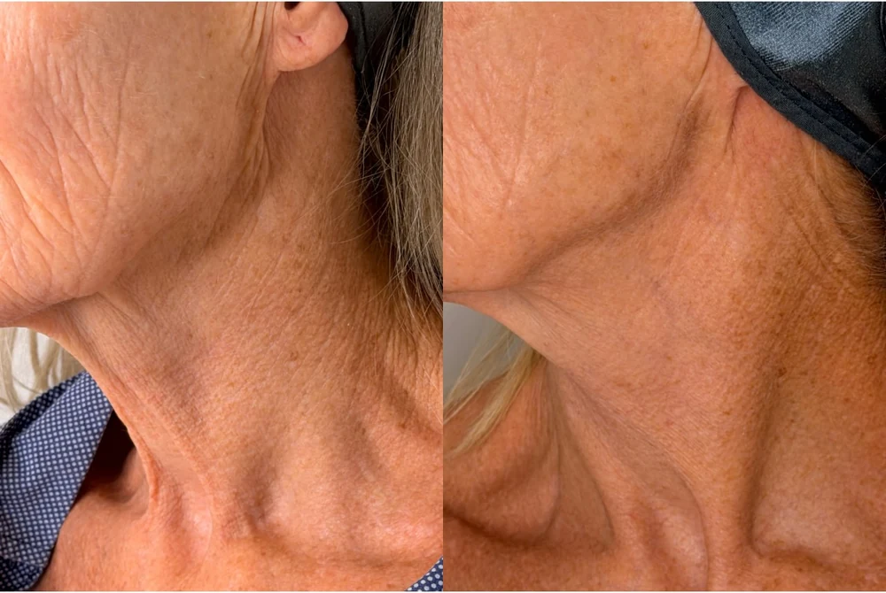 A client's jaw and neck before and after T33 cold plasma at HQ Aesthetics in Melville, Perth