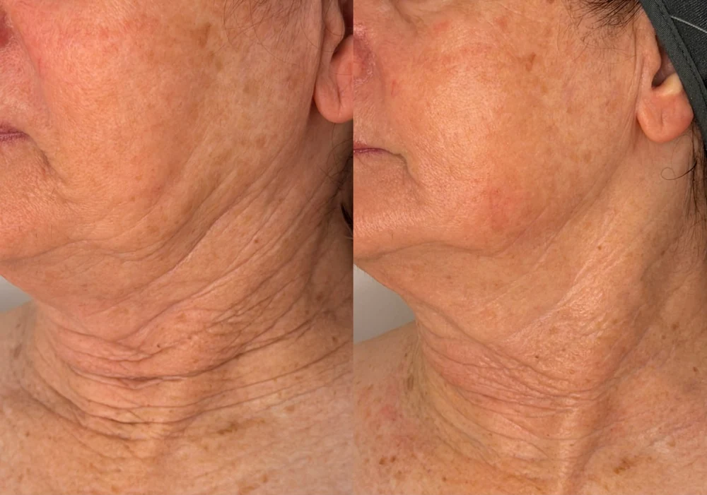 A second client's neck before and after T33 cold plasma at HQ Aesthetics in Melville, Perth