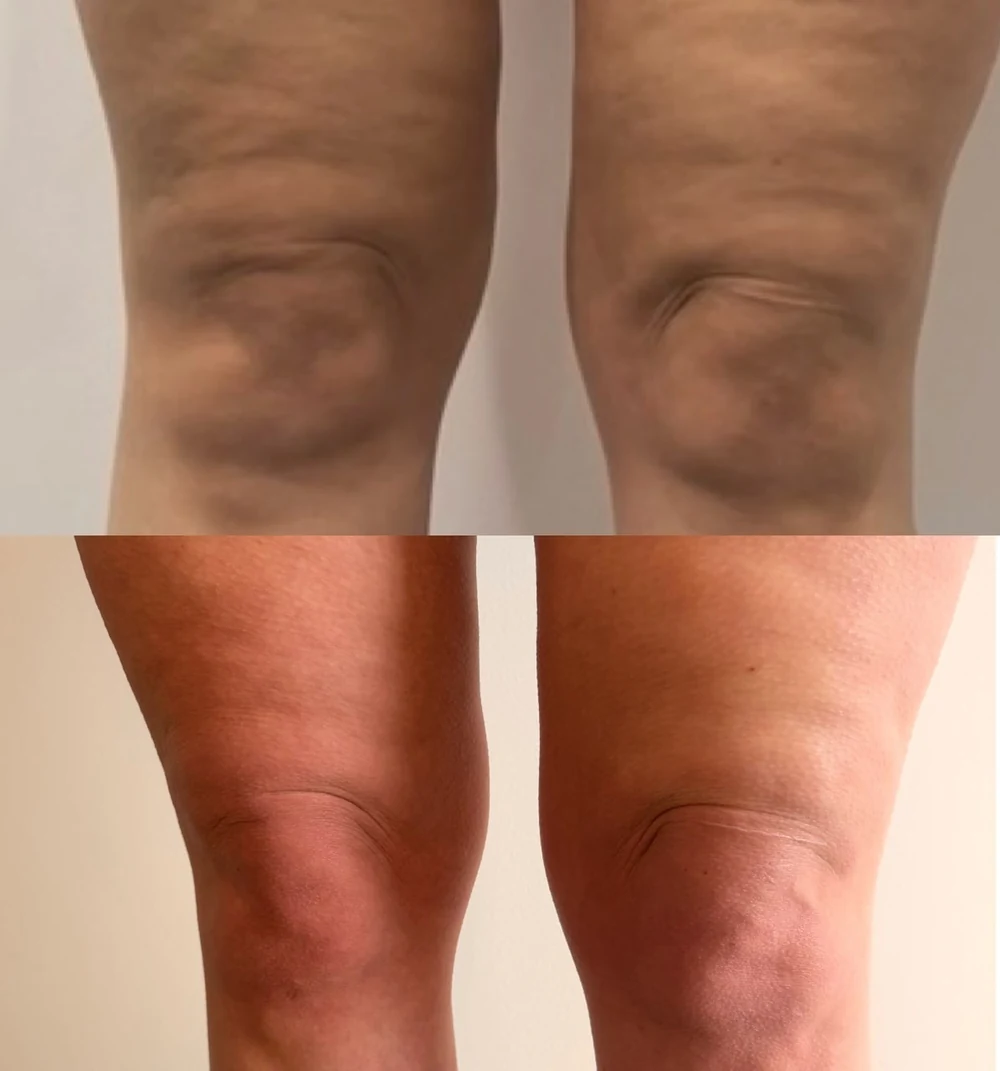 A client's knees before and after T33 cold plasma at HQ Aesthetics in Melville, Perth