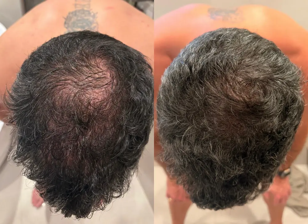 A client's scalp before and after T33 scalp and follicular stimulation at HQ Aesthetics in Melville, Perth