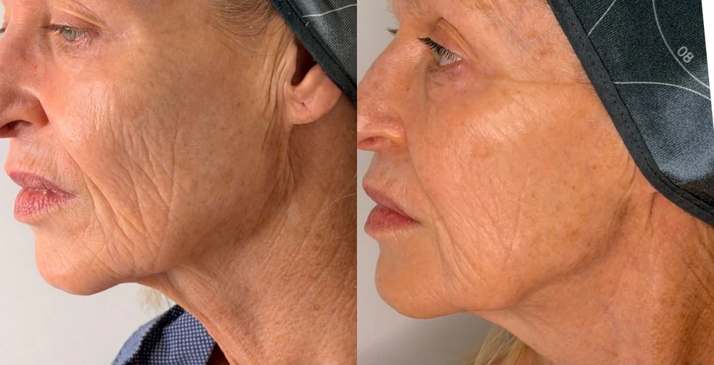 A client's face in profile before and after T33 cold plasma at HQ Aesthetics in Melville, Perth