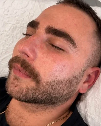 A client's cheek and jaw after skin needling at HQ Aesthetics in Melville, Perth