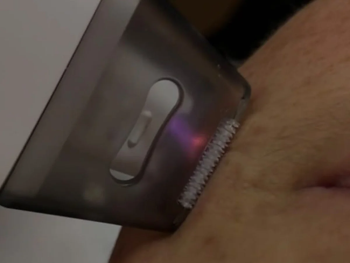 The ceramic rod tip of the T33 handpiece against skin, with the cold plasma discharge visible along the tip